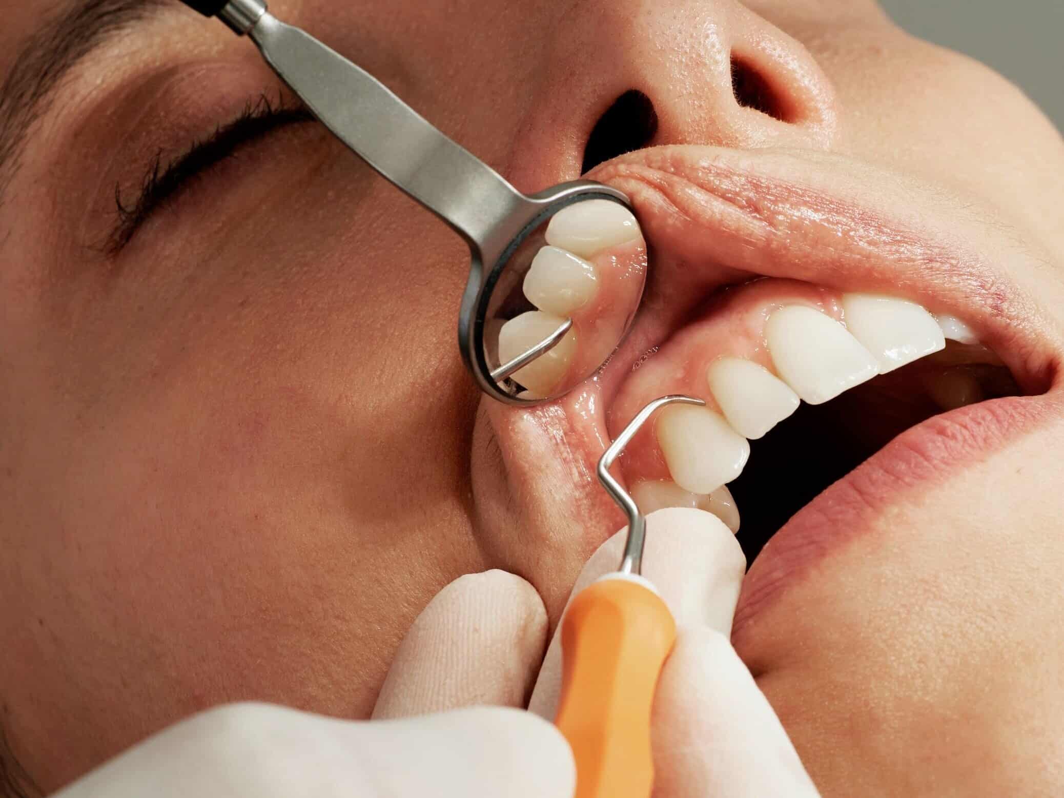 Periodontal Disease Treatment