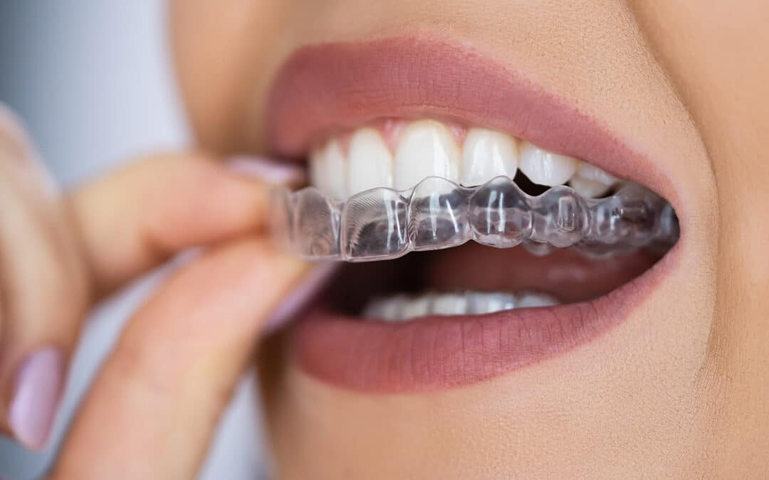 Invisalign Arlington VA