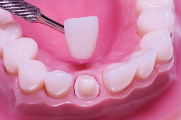 Dental Crowns
