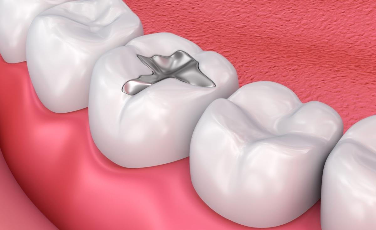 What Type of Dental Filling Is Right for Me?