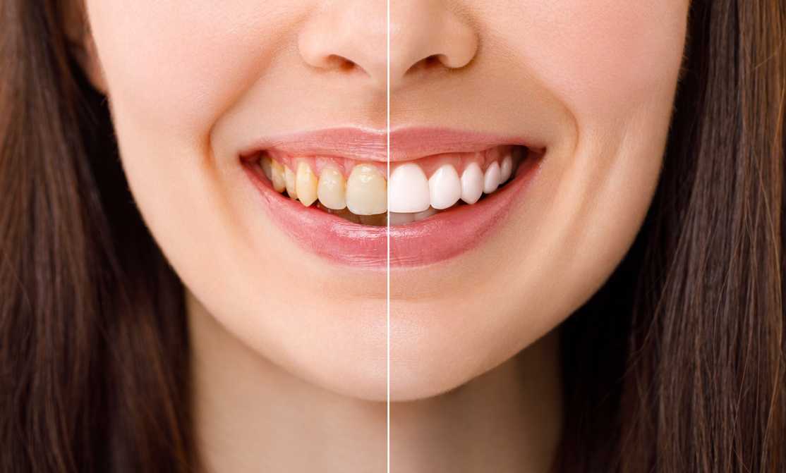 Teeth Whitening Arlington VA